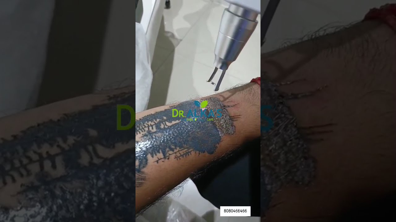 Say Goodbye to Unwanted Tattoos |Painless Tattoo Removal Results You Can Trust 