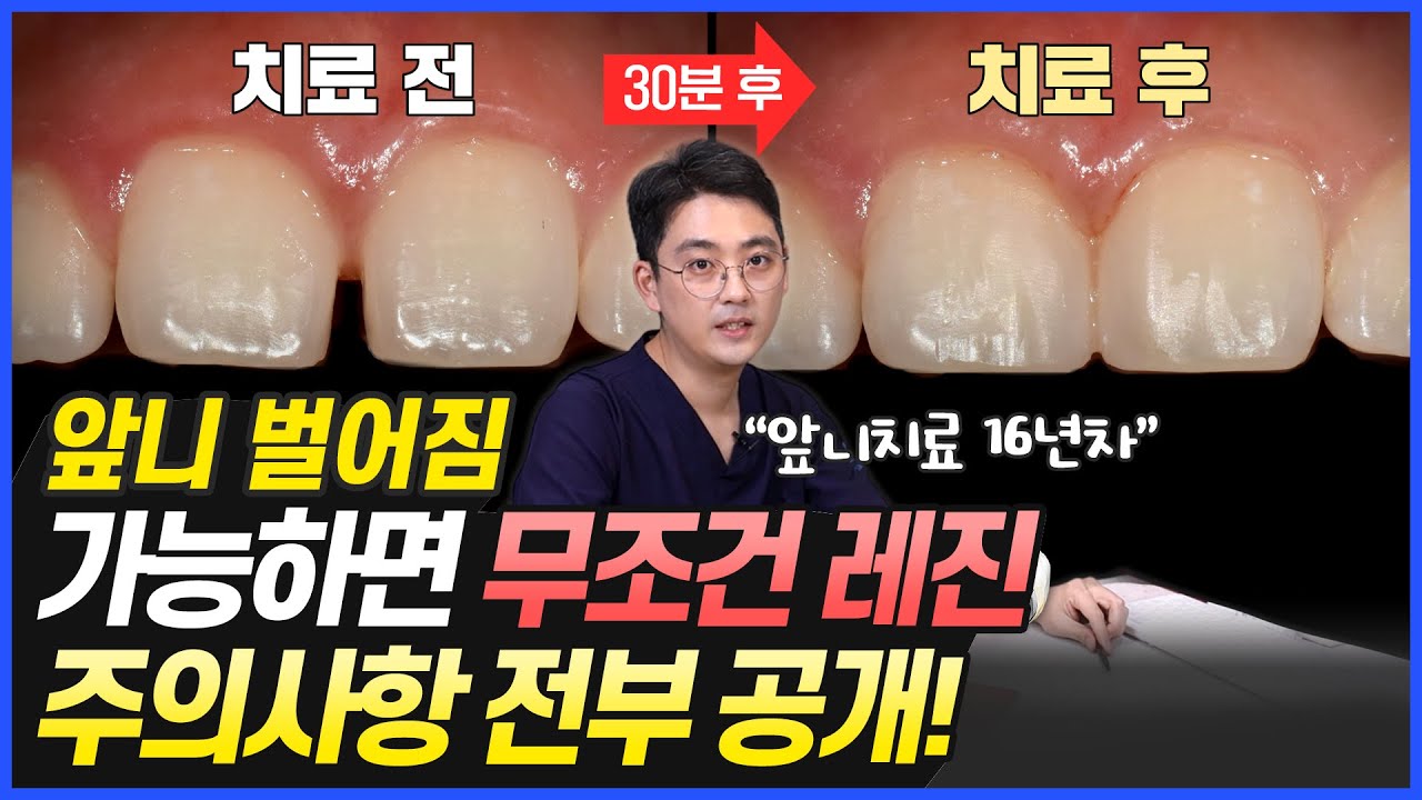 앞니 벌어짐, 가능한 레진으로 해야 합니다. | 앞니 벌어짐 치료 주의사항, 전부 공개합니다!