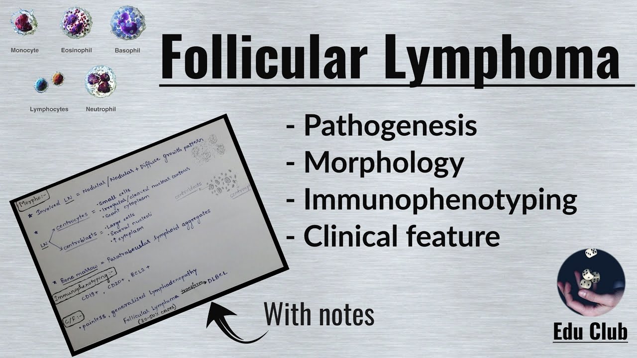 Follicular lymphoma | Non Hodgkin's Lymphoma || Pathology