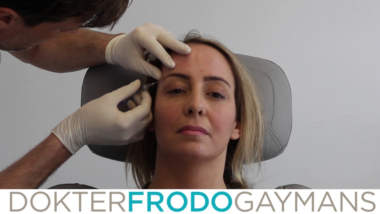 Ooglift met fillers - C-ooglift
