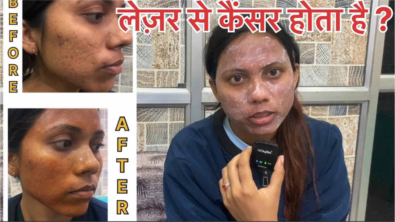 Laser se cancer hota h? Acne scar,pimple mark.🔥