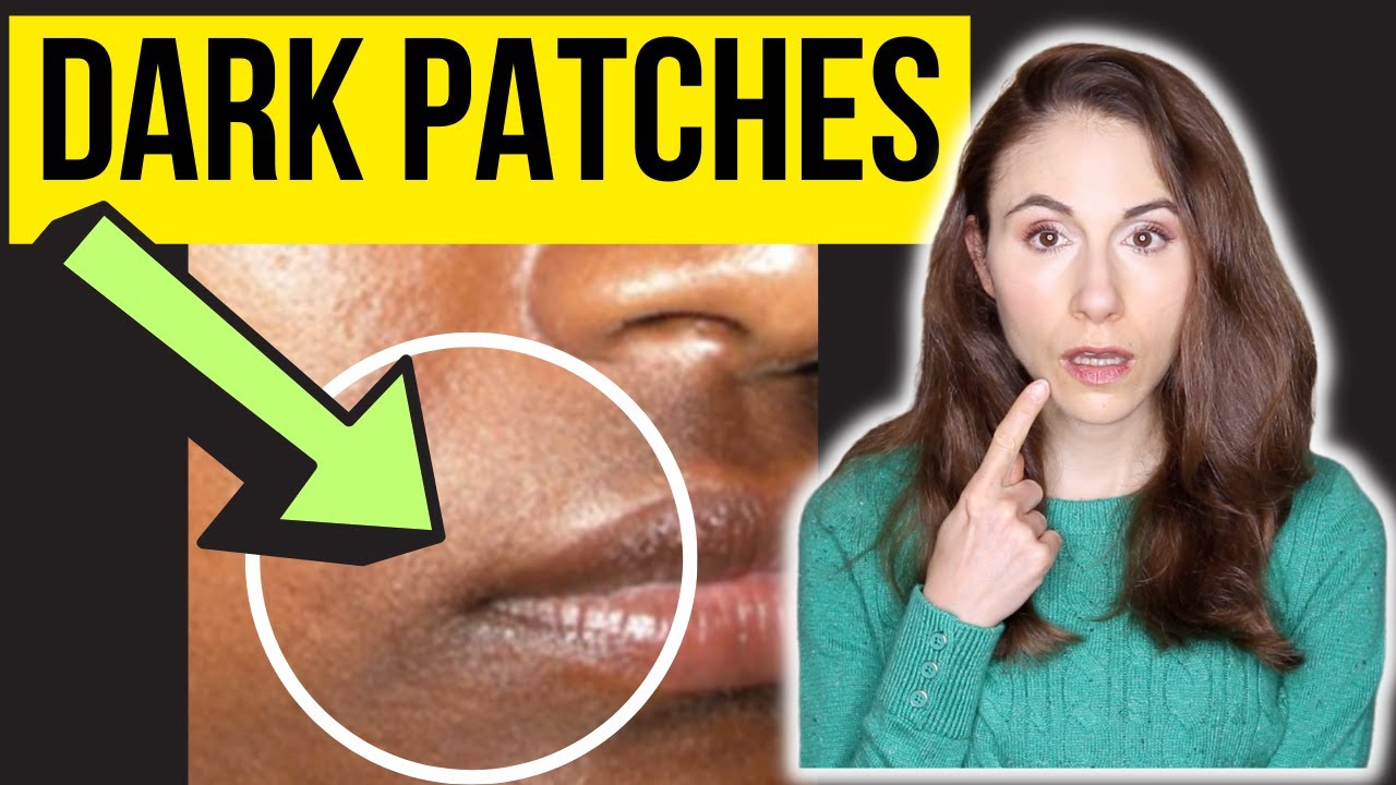 Dermatologist Explains Dark Patches Around The Mouth