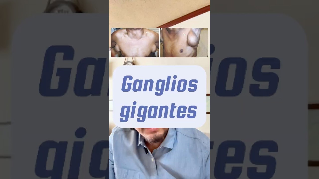 👀 Cuando los ganglios crecen sin control