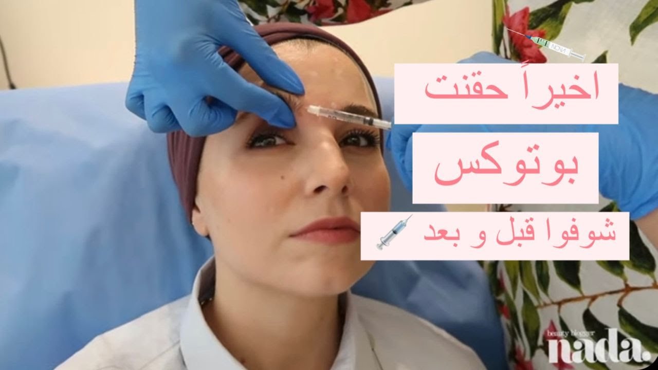 تجربتي مع البوتوكس ، اهم النصائح بعد الحقن 💉 || My Experience with BOTOX