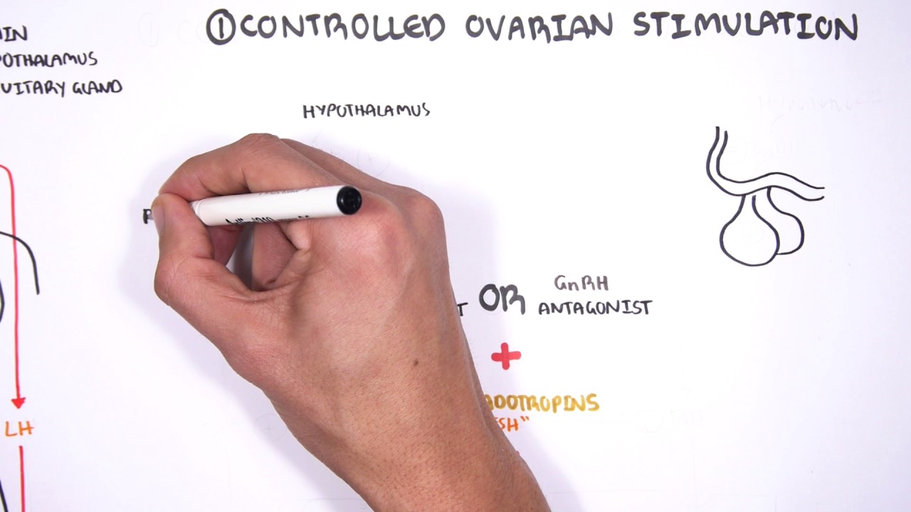 In Vitro Fertilization (IVF) - Overview