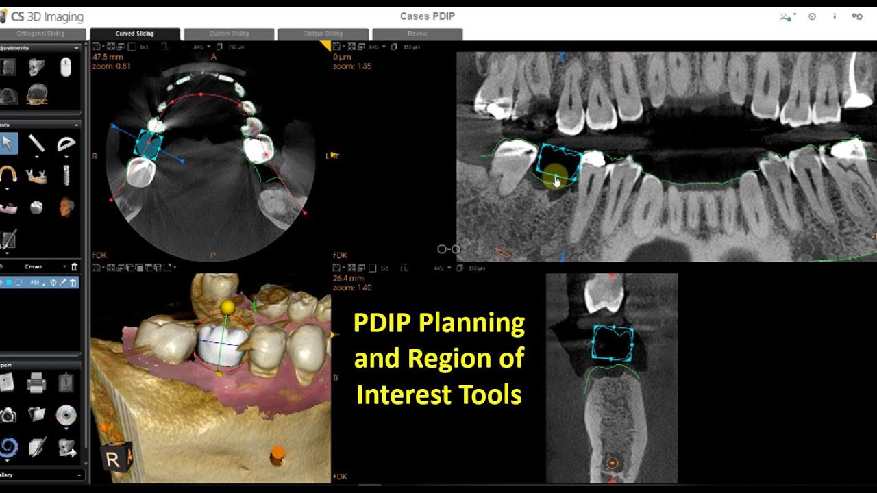 CS 3D Imaging Версия 3.10.12 - Планирование имплантации. Часть 3 - Инструменты планирования PDIP ...