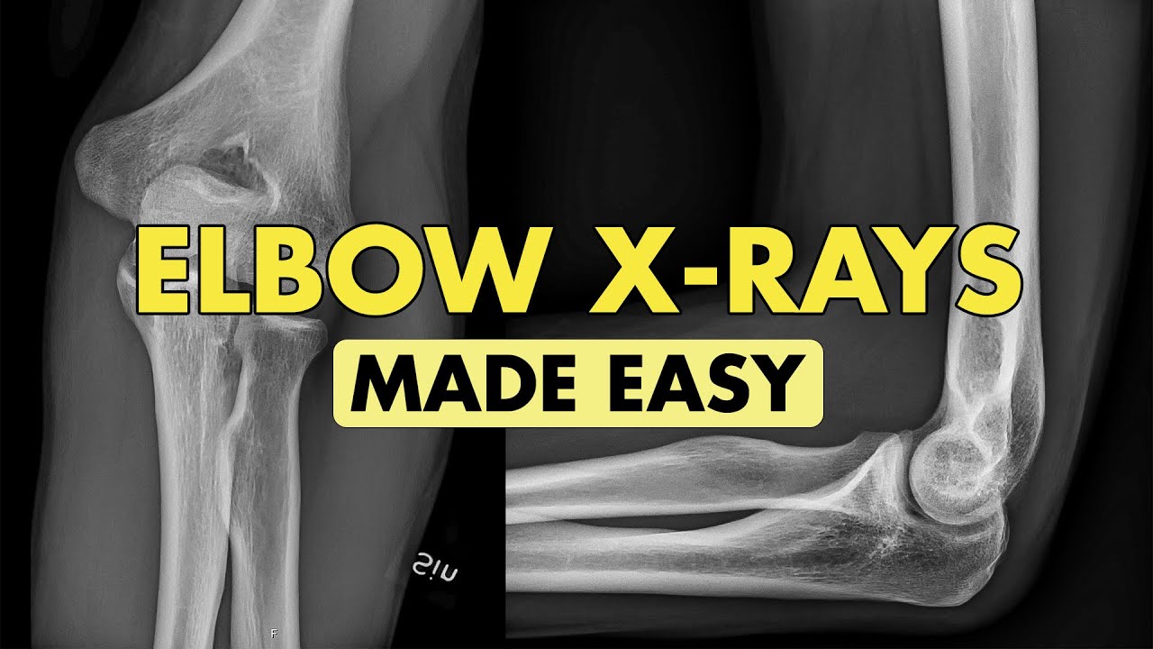 Elbow X ray Interpretation Explained and Simplified
