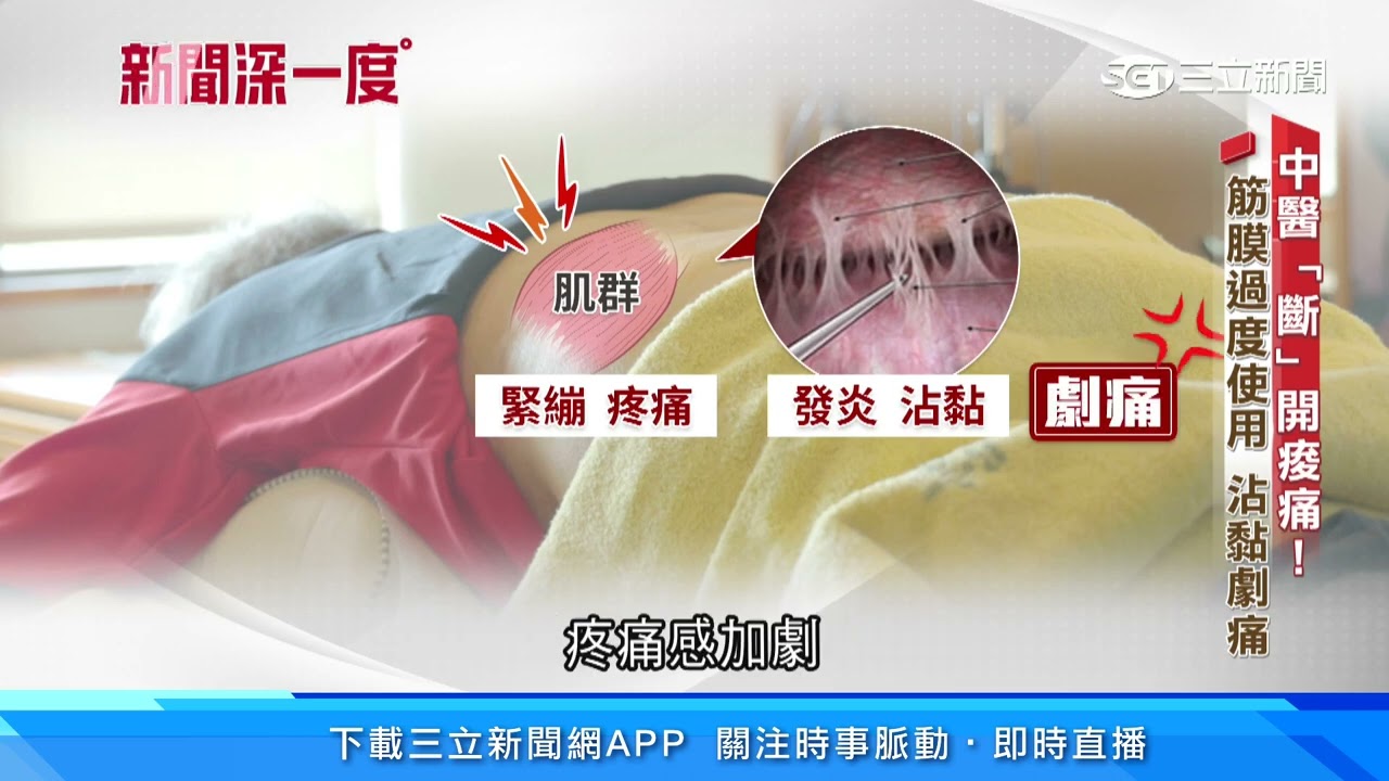 腰酸背痛困擾600萬人 「小針刀」鬆開沾黏處｜三立新聞網 SETN.com