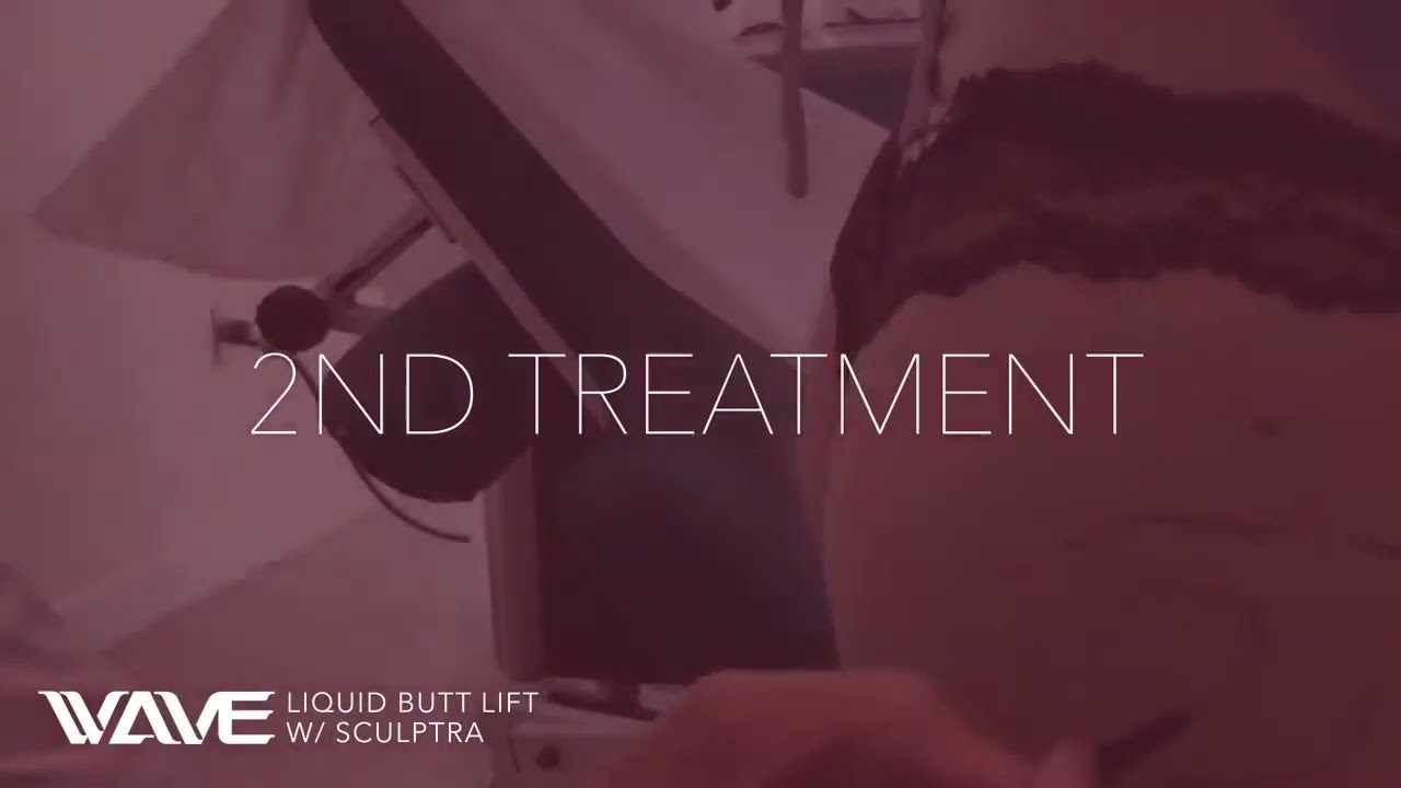 Sculptra - Butt Lift | Rejuvenus Clinic | Toronto