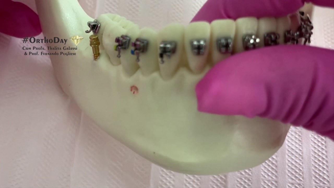 Instalação Buccal Shelf