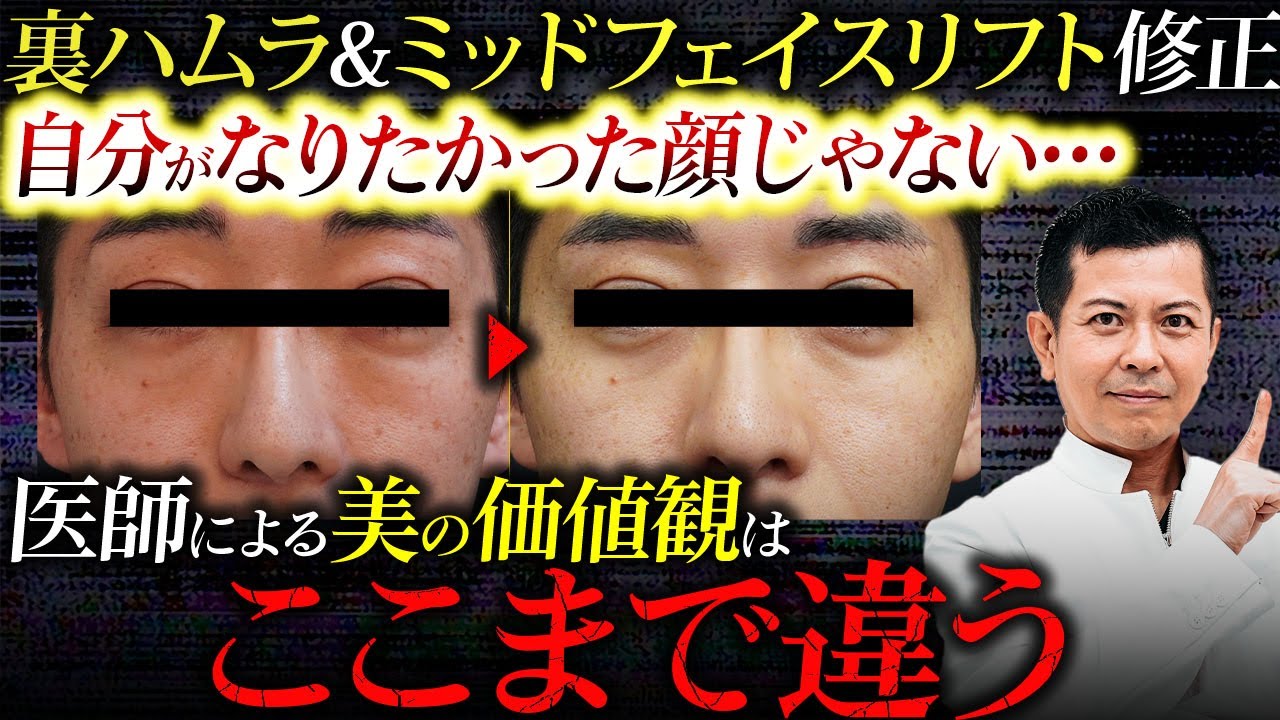 【クマ治療】実力派ハムラドクターのハムラ&ミッドフェイスリフトを修正し自然で美しい姿へ！美容外科医における