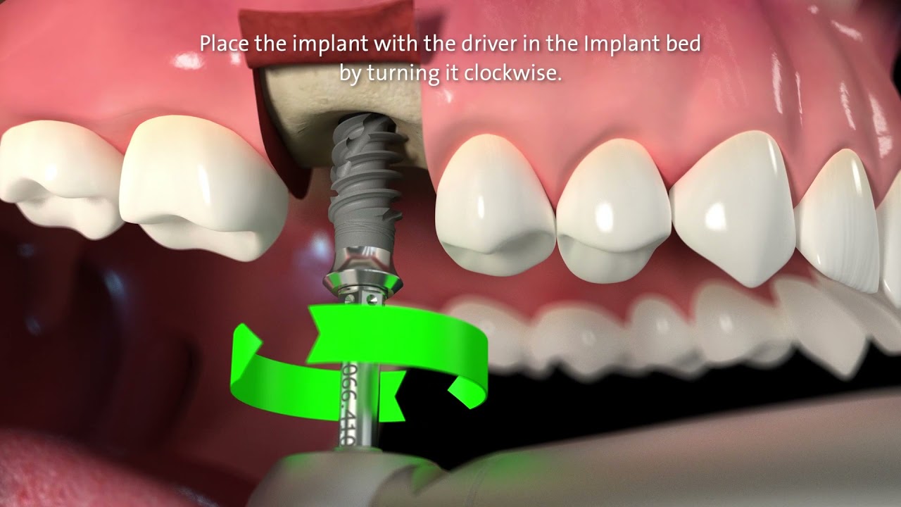 Straumann&reg; TLX Implant System Step by Step