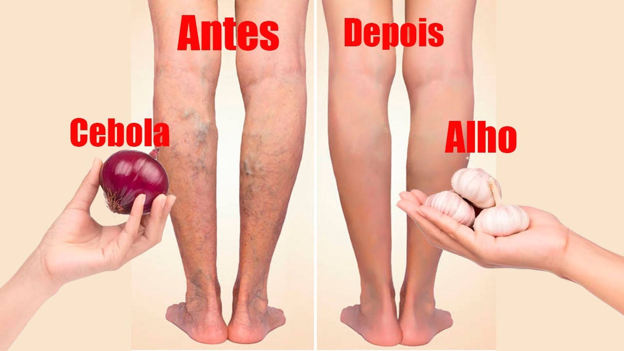 Goodbye Varicose Veins and Leg Pain! Simple and easy tip that erased varicose veins! 🤯