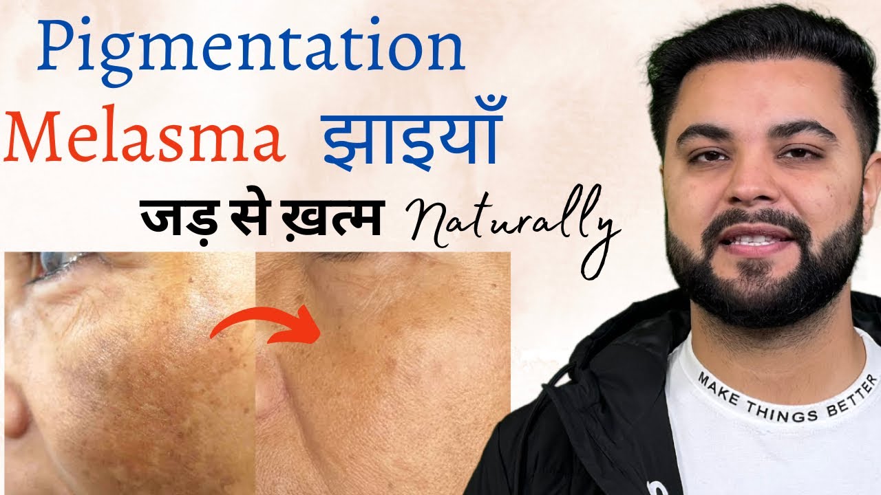 100% излечение пигментации, мелазмы, темных пятен и веснушек с помощью натурального домашнего сре...