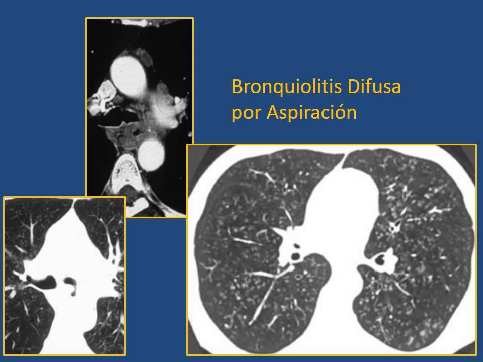 Patologia Peque&ntilde;a via aerea