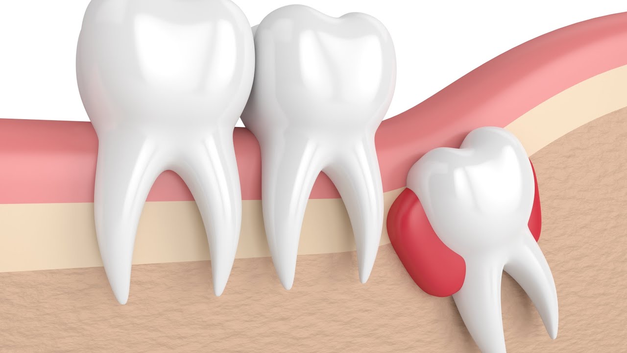 Impaction Part 1