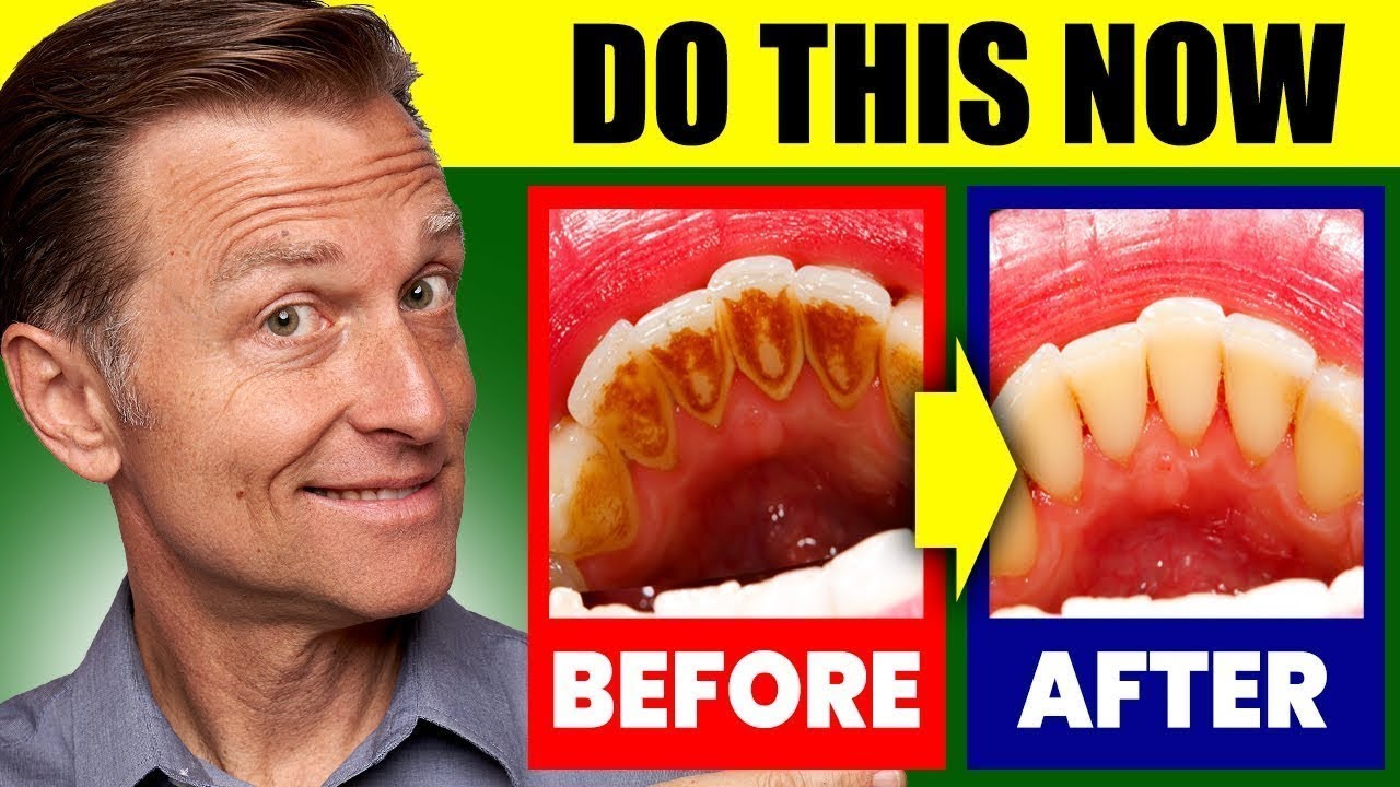 🦷 Natural Solution for Plaque, Cavities, and Gingivitis | Dr. Eric Berg | Health Motivational Speech