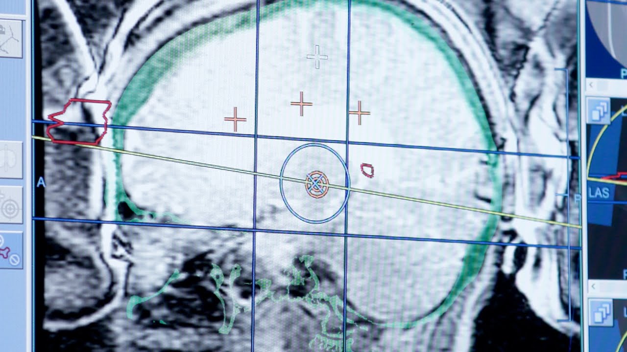 A Steady Hand: Treating Essential Tremor with Focused Ultrasound