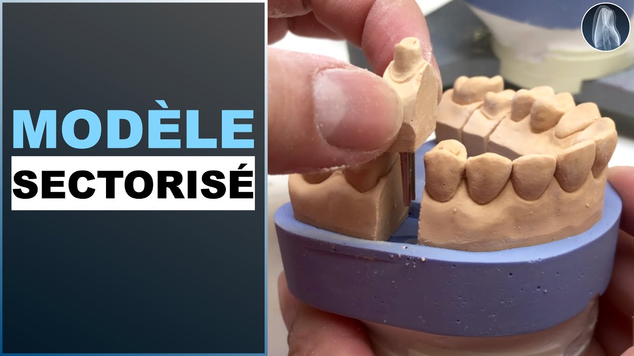Créer un modèle sectorisé parfait pour une prothèse inamovible | Guide complet étape par étape 🦷