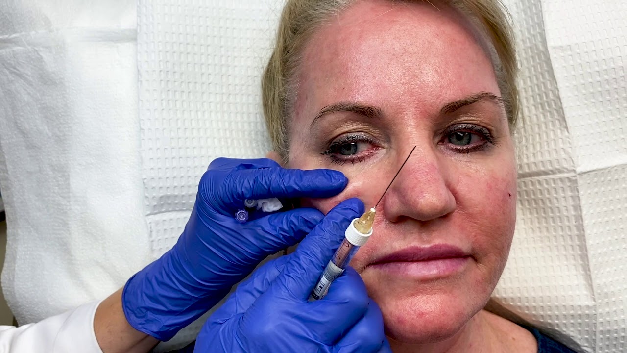 Mid-Face Filler with Dr. Sarhaddi