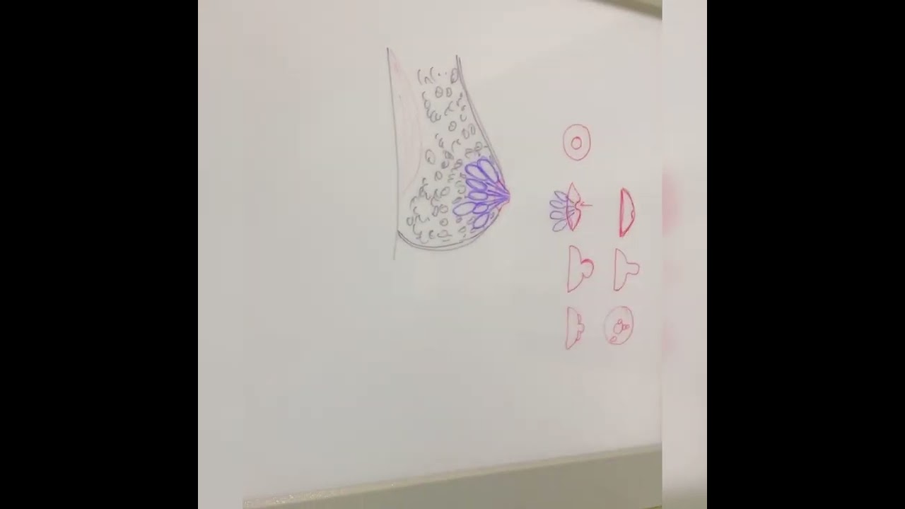 Çökük meme ucu (inverted nipple) nedir ? Nasıl düzeltiyoruz ?