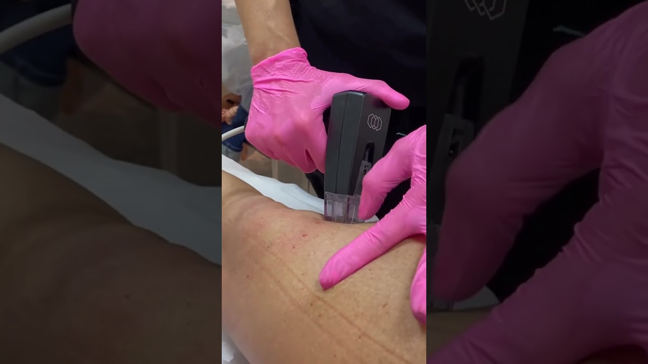 Conhe&ccedil;a a tecnologia mais revolucion&aacute;ria para tratamento de flacidez: morpheus 8 #shorts #bodytite