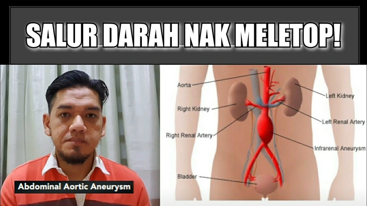 Penyakit Salur Darah Bengkak - Tunggu MELETUP!!!