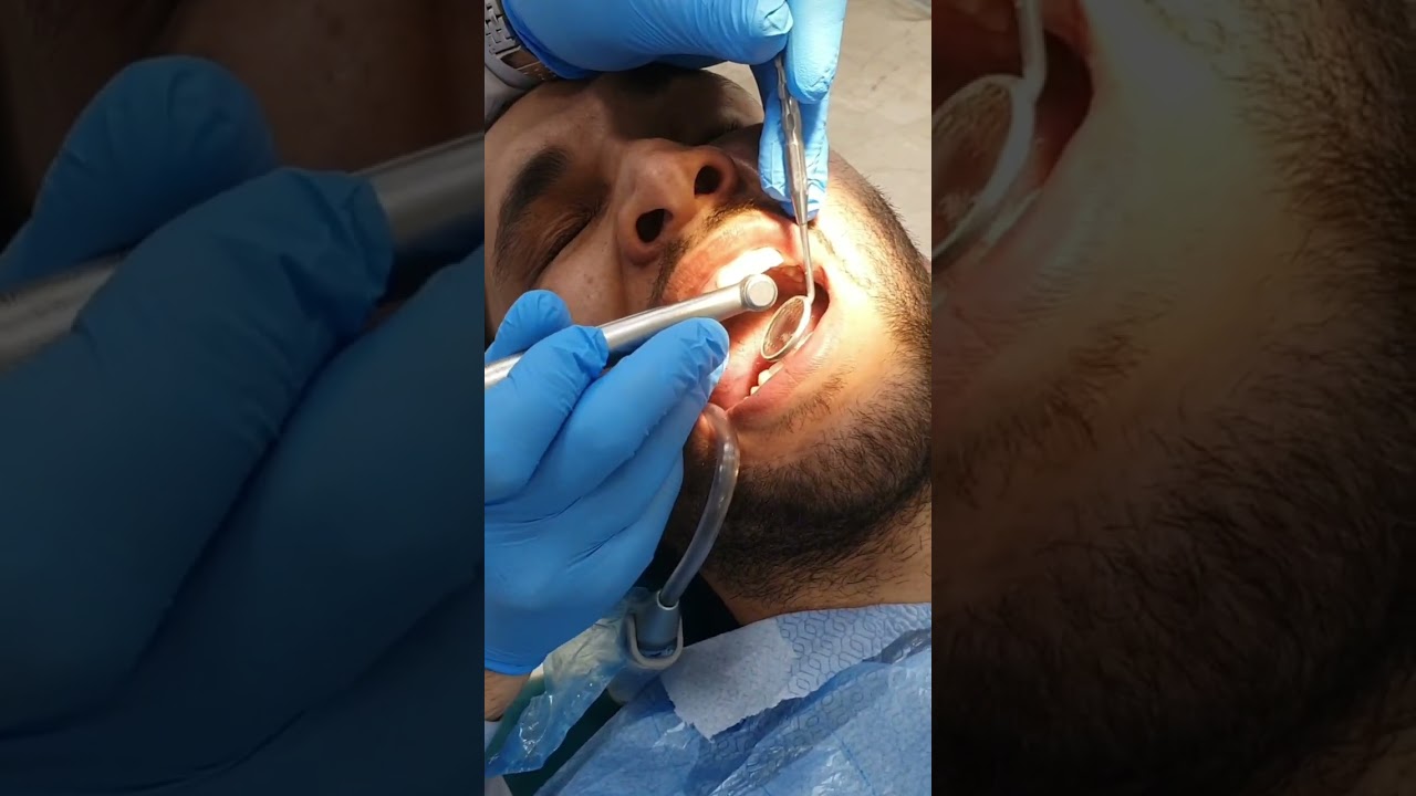 Zircon Crown, Clinical Case
