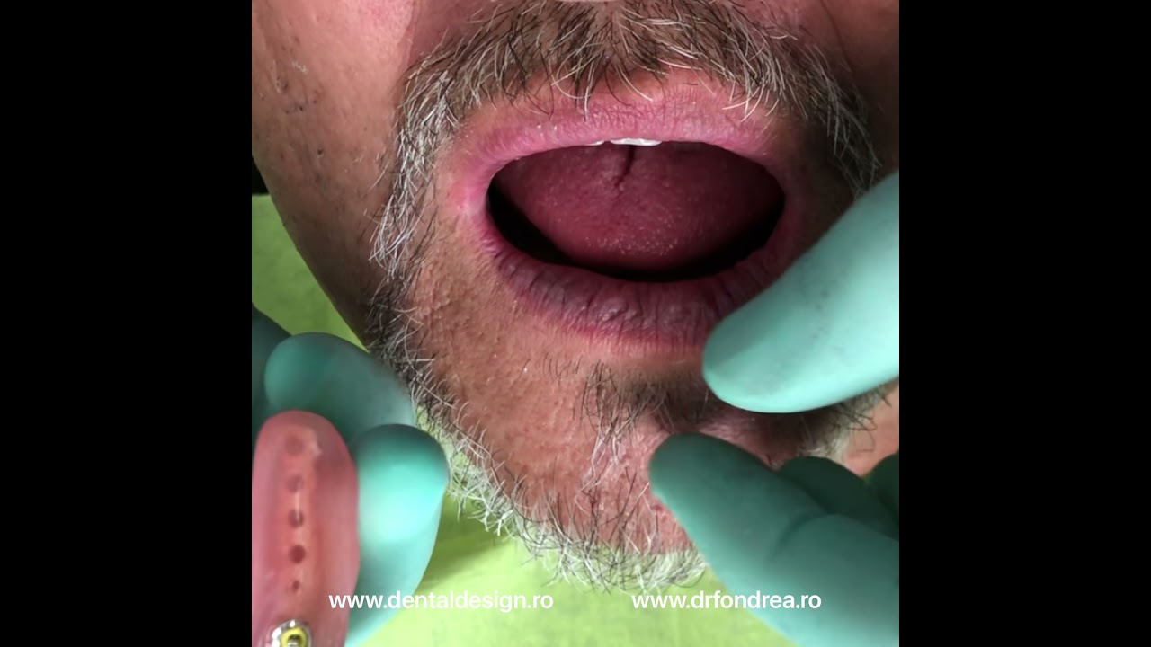 Dr. Fondrea, Dental Design Timisoara - cazul clasic: supraprotezare pe implanturi si proteza totala