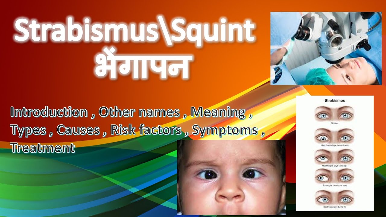 Squint | भेंगापन | Strabismus full explained in Hindi