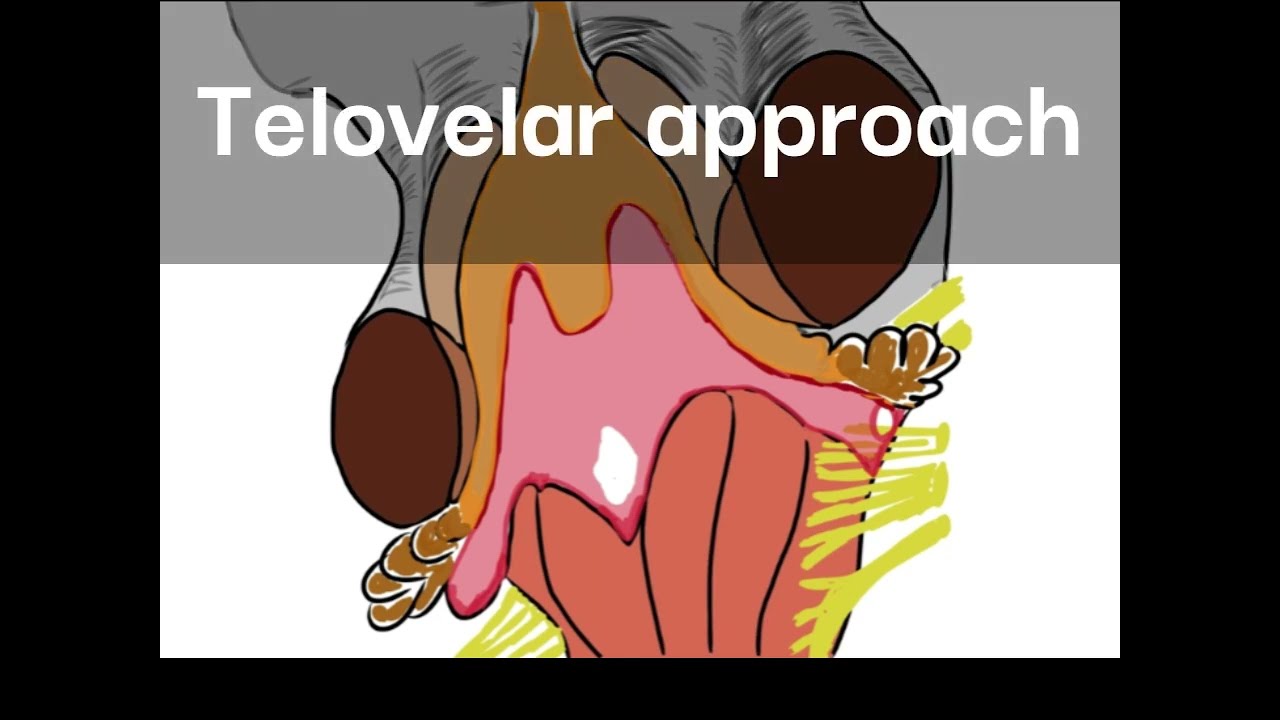 Telovelar approach