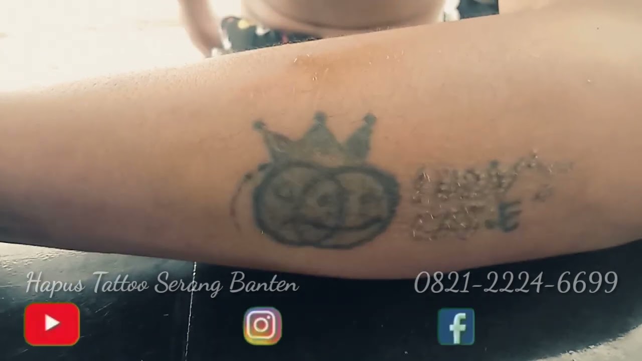 PROSES HAPUS TATTOO LASER