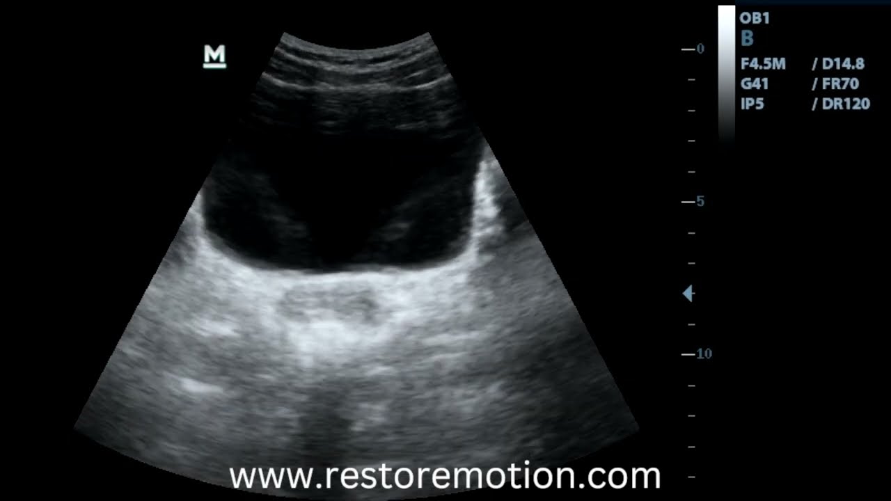 Healthy Pelvic Floor Mobility Visualized with Dynamic Ultrasound