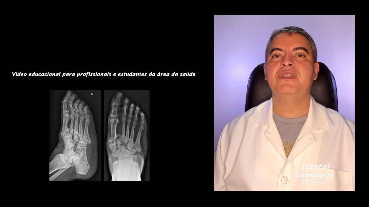 Artropatia de Charcot