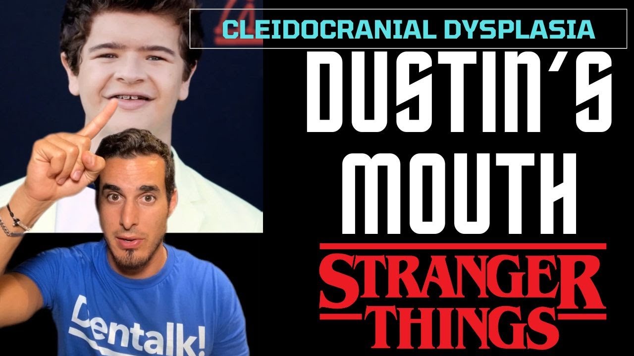 STRANGER THINGS  - The rare disease that affects Dustin&rsquo;s teeth - Cleidocranial Dysplasia