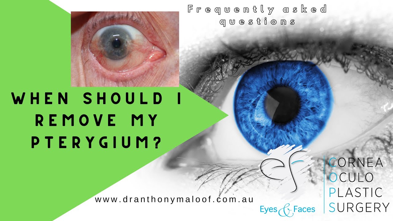 FAQ - When should I remove my Pterygium - Dr Anthony Maloof, Sydney
