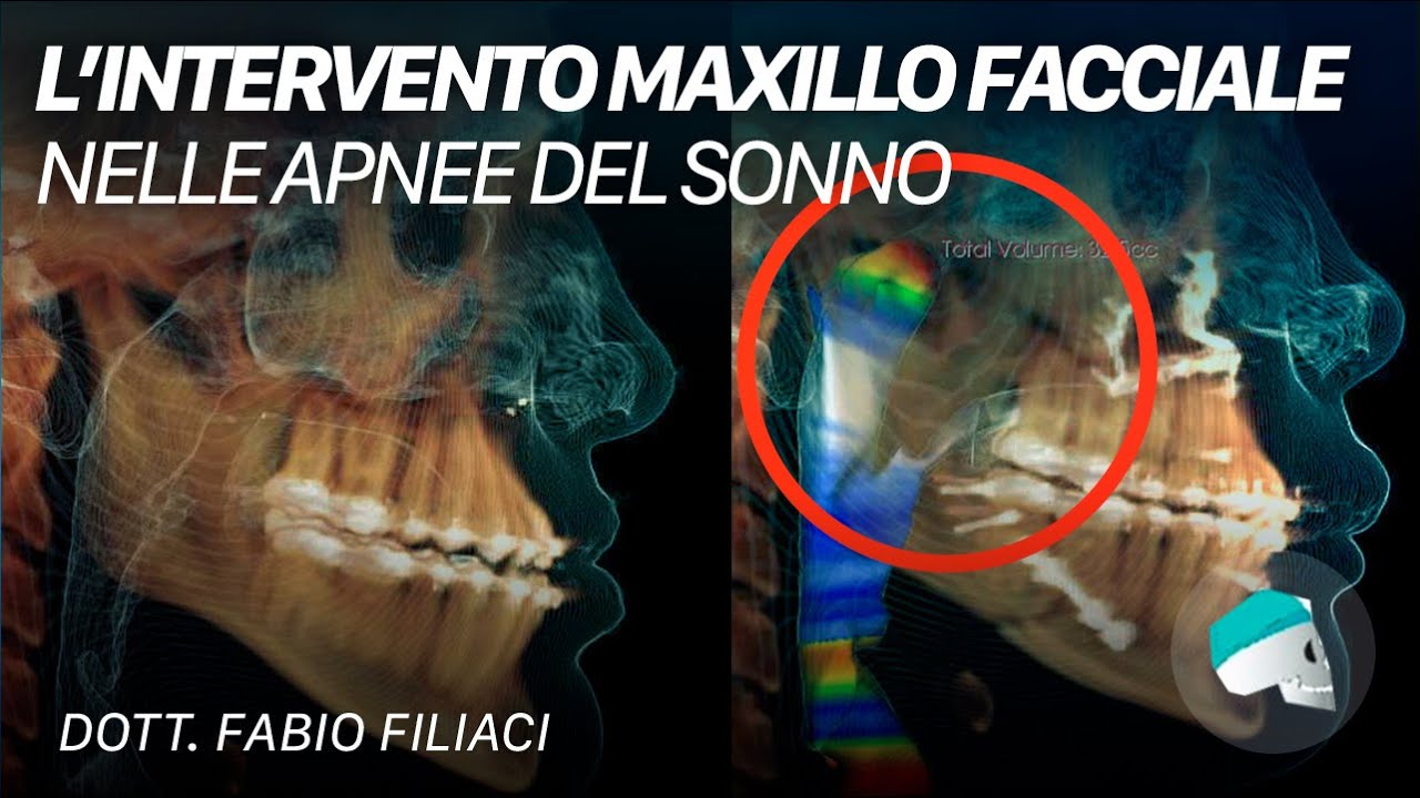 Chirurgia maxillo facciale (avanzamento maxillo - mandibolare o bimascellare) nelle apnee notturne