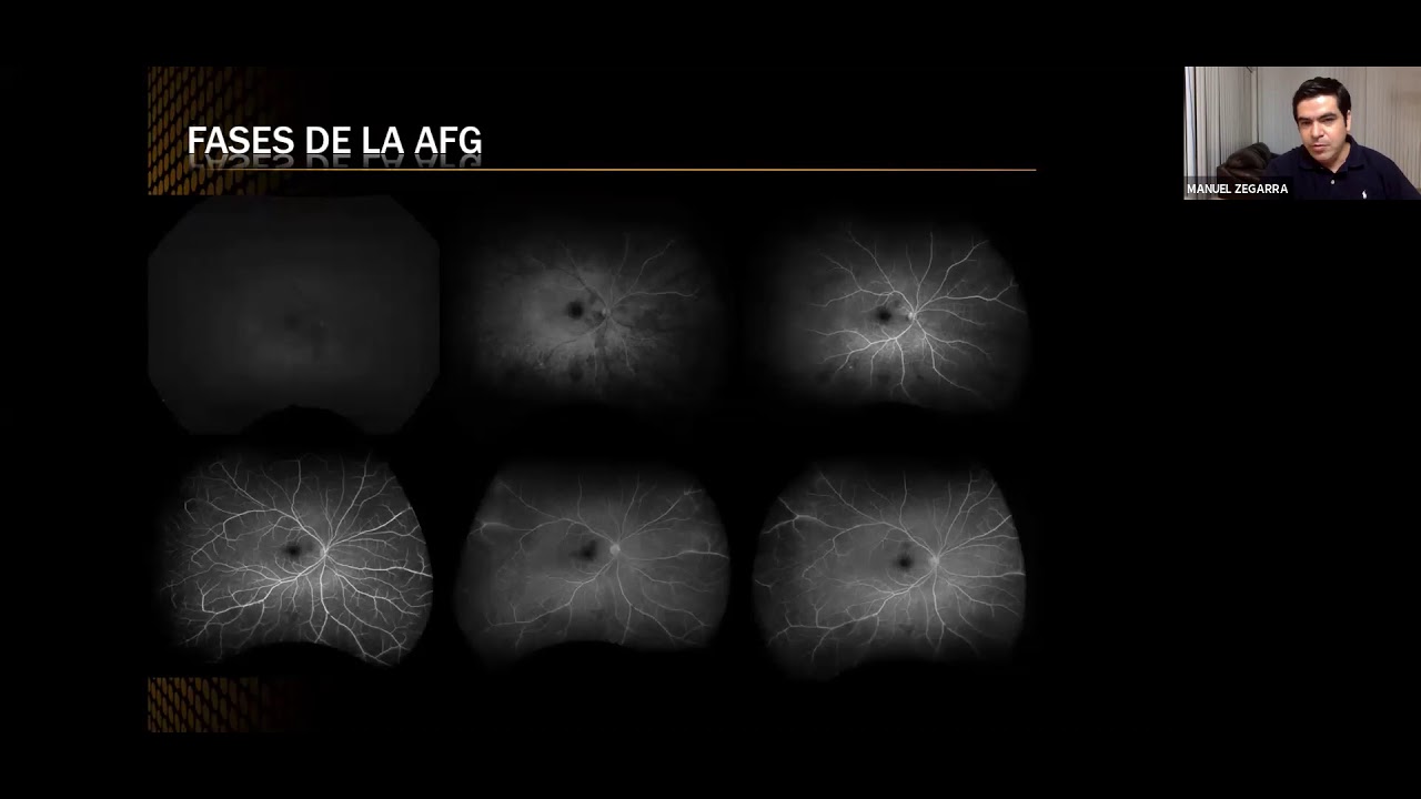 FLUORANGIOGRAFIA VS ANGIO OCT