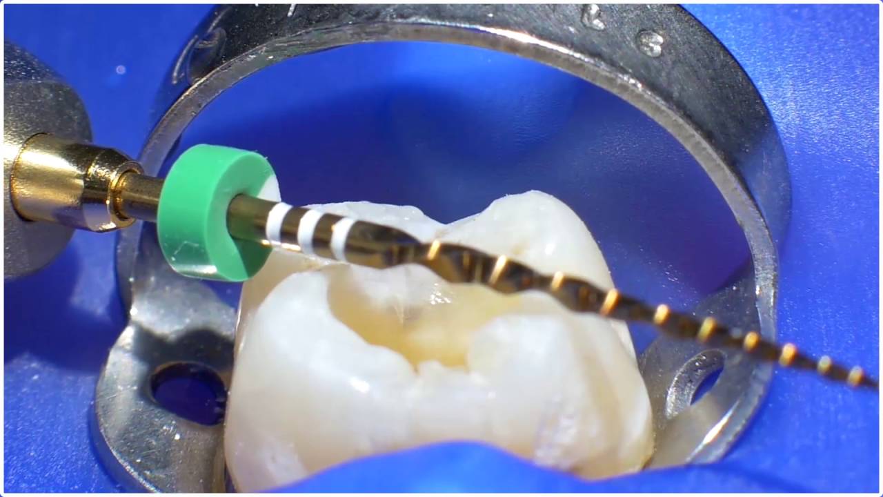 WaveOne Gold &reg; Technique - Dr. Willy Pertot | Dentsply Sirona