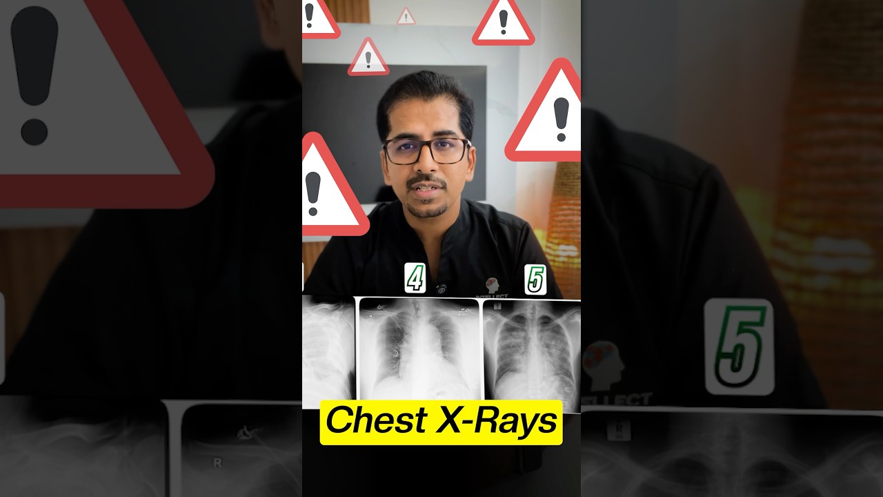 5 Chest X-rays that need Immediate Action (Must know) #xray #cxr #icu