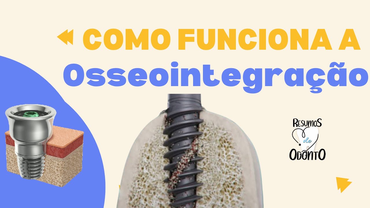 Osseointegração |Resumos de Odonto