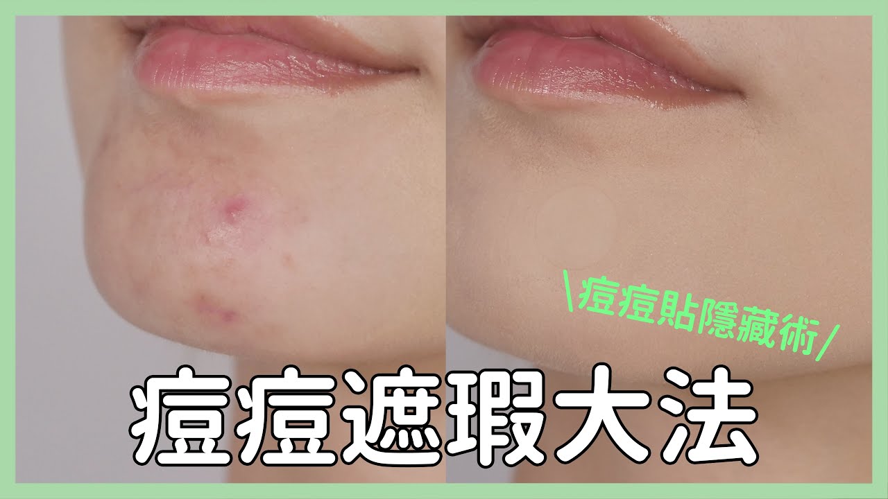 #新手必看60 巨痘一秒隱形《痘痘貼遮瑕大法》爆痘期也能水水出門｜Astor