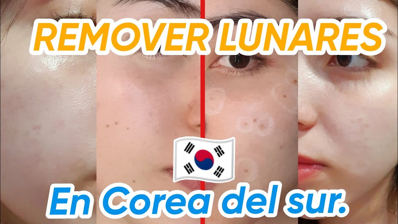 REMOVÍ MAS DE 15 LUNARES FACIALES EN COREA! @meclinicseoul | Nicolisa