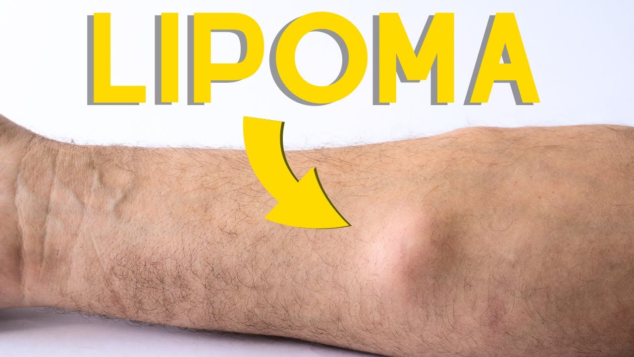 Уплотнение или шишка под кожей? Доброкачественная мезенхимальная липома.