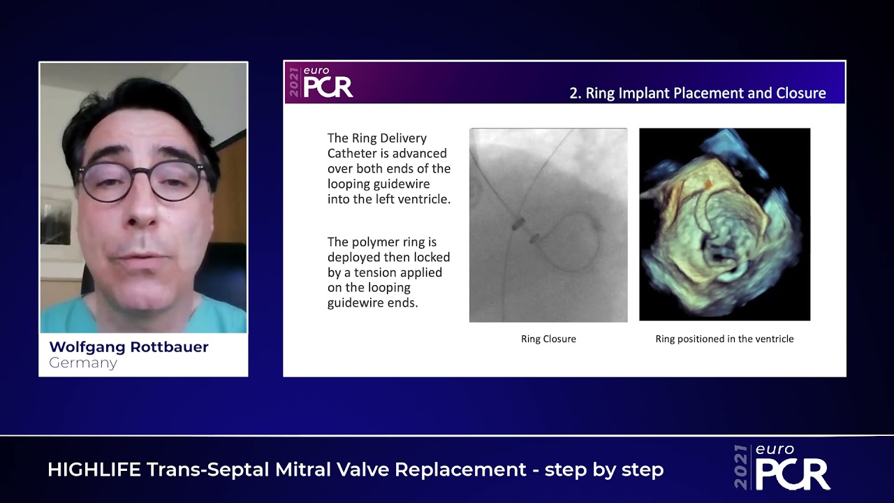 HIGHLIFE Trans-Septal Mitral Valve Replacement (TSMVR) - step by step - EuroPCR 2021