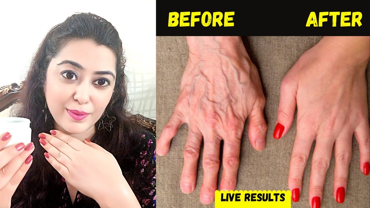 Remove Wrinkles from Hands | Make your Hands Look 10 Years Younger - Get Baby Soft Hands - Dry Hands