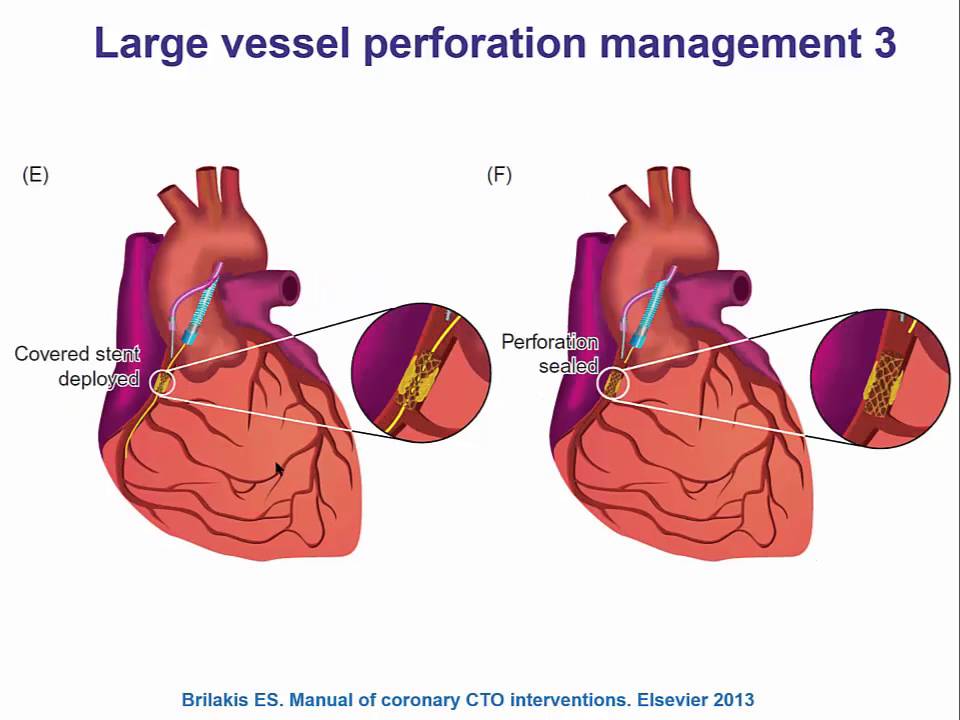 Как лечить перфорацию коронарной артерии магистрального сосуда: шаг за шагом