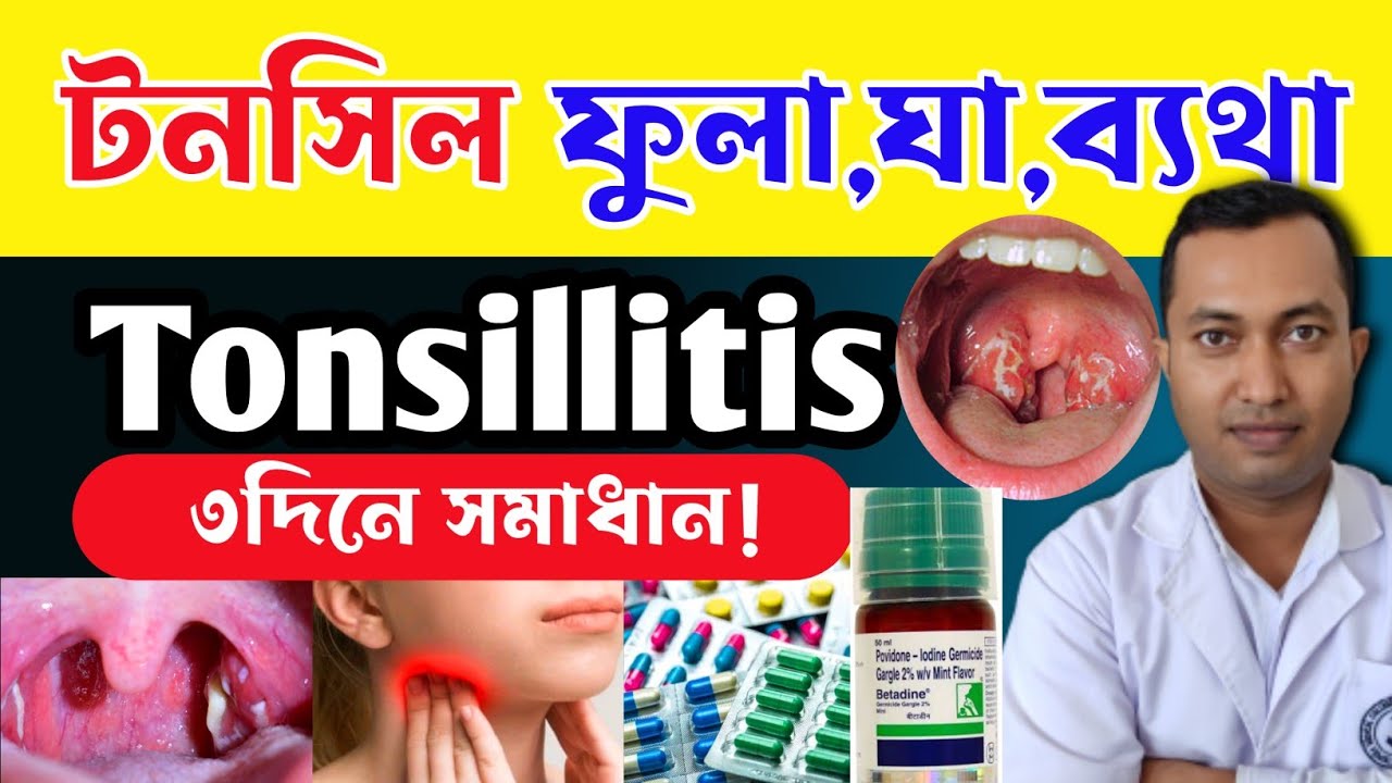 গলাতে ব্যথা যন্ত্রণা টনসিল ফুলে আছে কি করবেন| টনসিলের সমস্যা হলে কি করবেন|