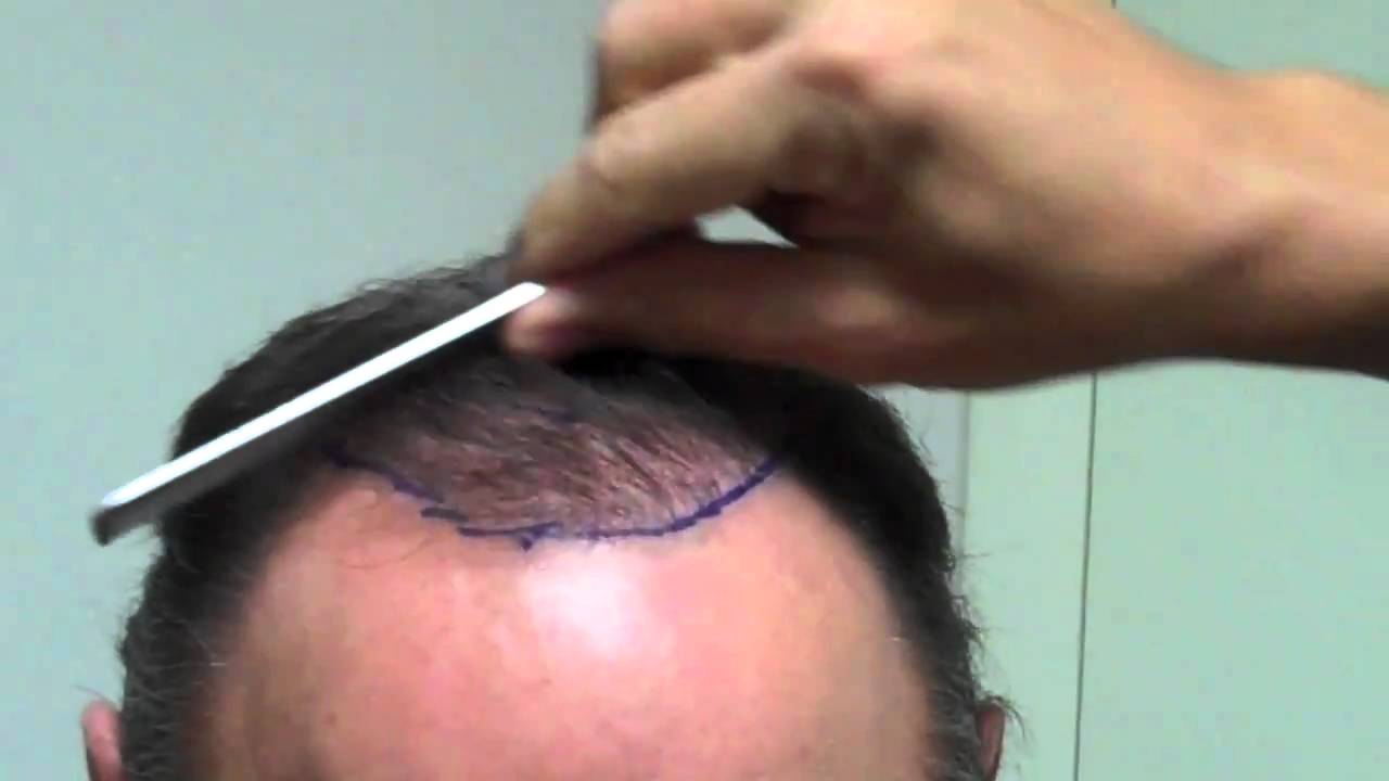 Dr. Jeffrey S. Epstein - Revision Hair Transplant - Male Patient