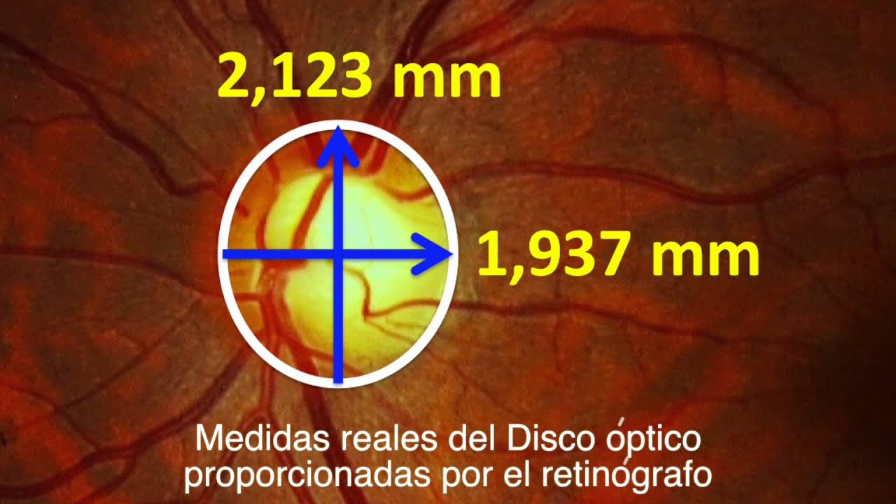 Fondo de ojo - Parte I - Disco óptico o papila - Centro de Oftalmología Bonafonte
